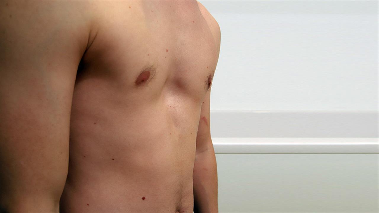 воронкообразная грудь у мужчин фото 112