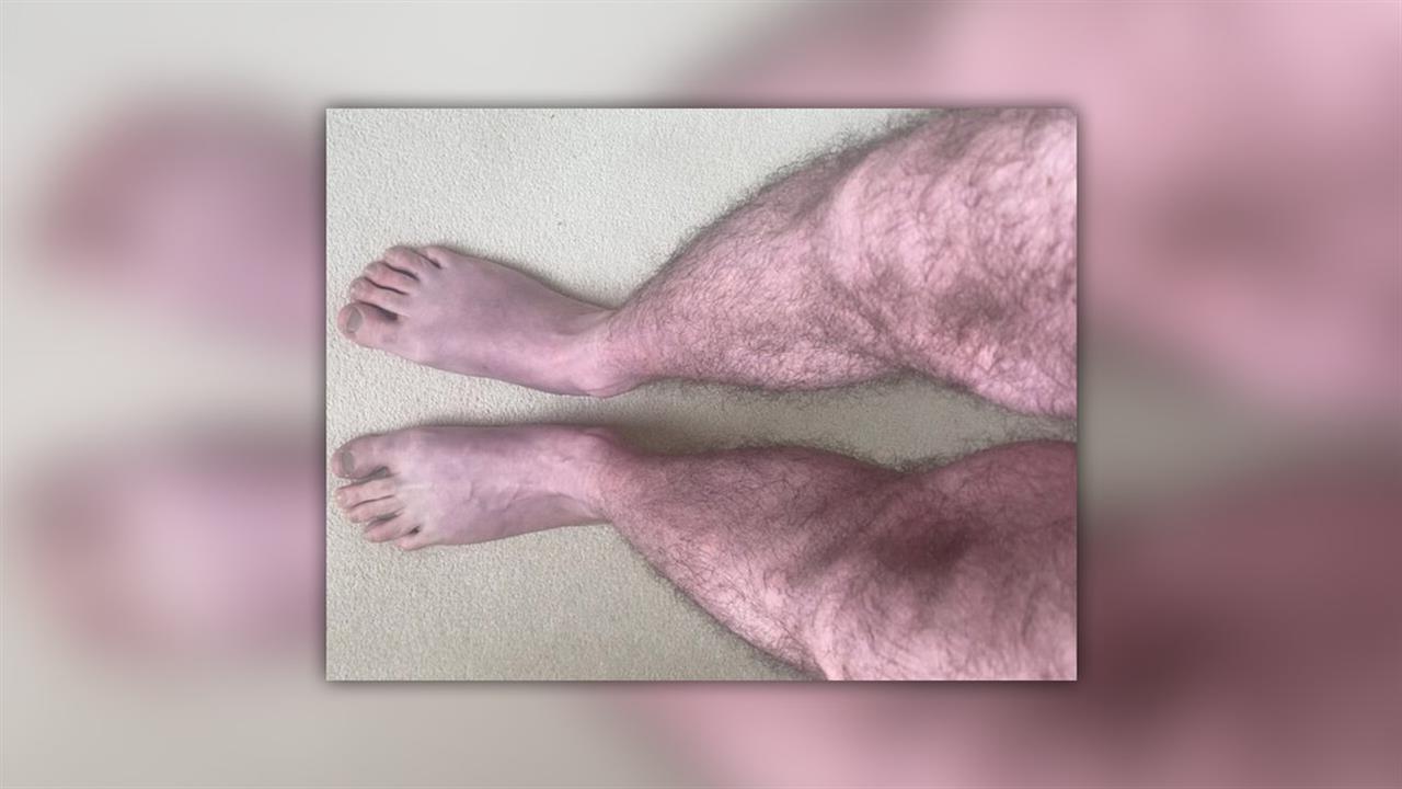 Περιστατικό ασθενούς με μπλε πόδια σε ορθοστασία λόγω long COVID