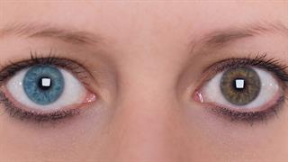 Ετεροχρωμία: Όταν τα μάτια έχουν διαφορετικό χρώμα