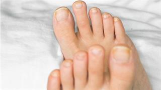 Λευκά σημάδια στα νύχια των ποδιών: Τι σημαίνουν;