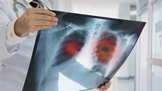 Σημαντικές εξελίξεις στην αντιμετώπιση του καρκίνου του πνεύμονα